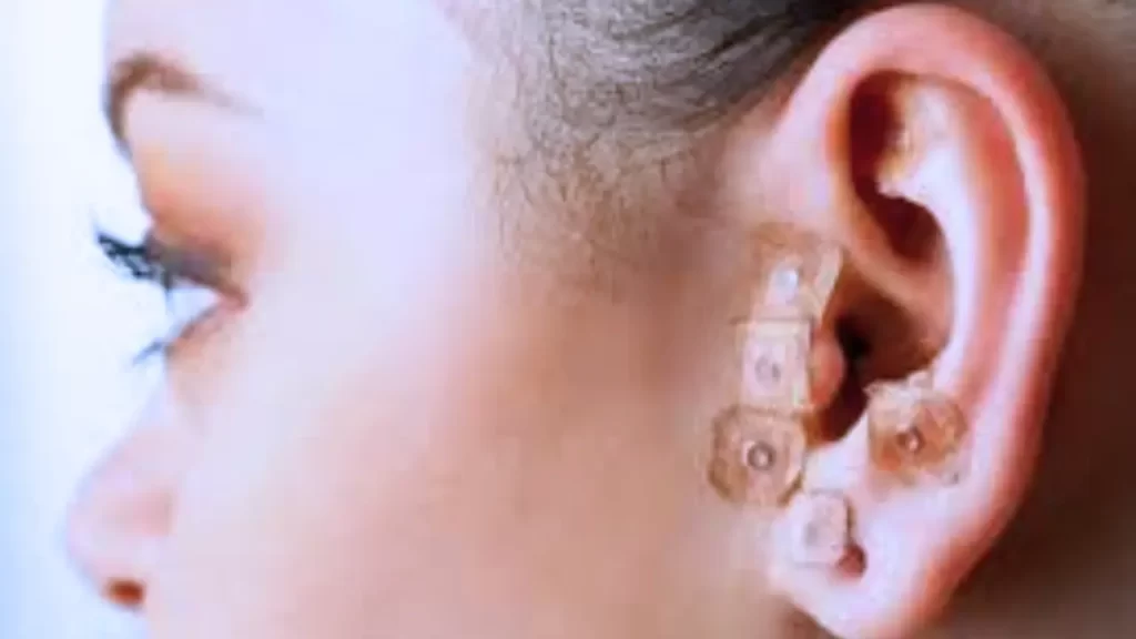 acupuntura